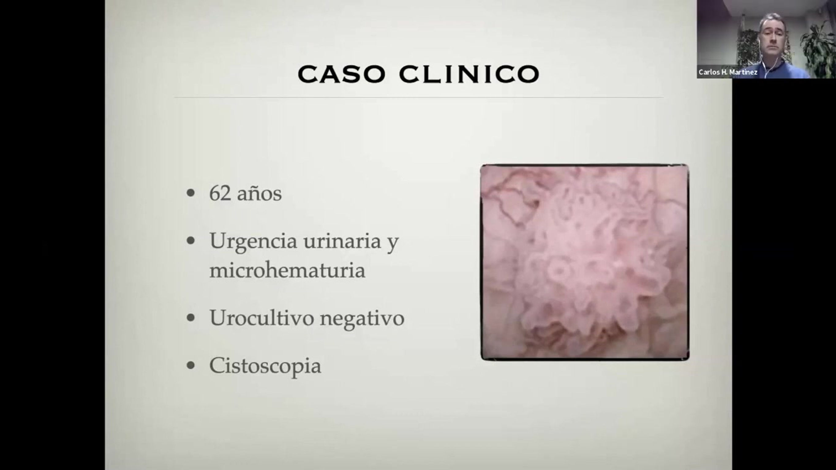 Actualización en Cáncer de vejiga no músculo invasivo (1)